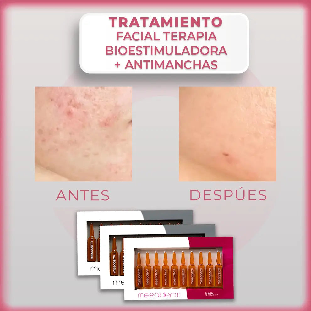 Tratamiento Facial Bioestimulador + Antimanchas