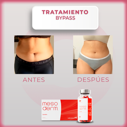 Tratamiento bypass