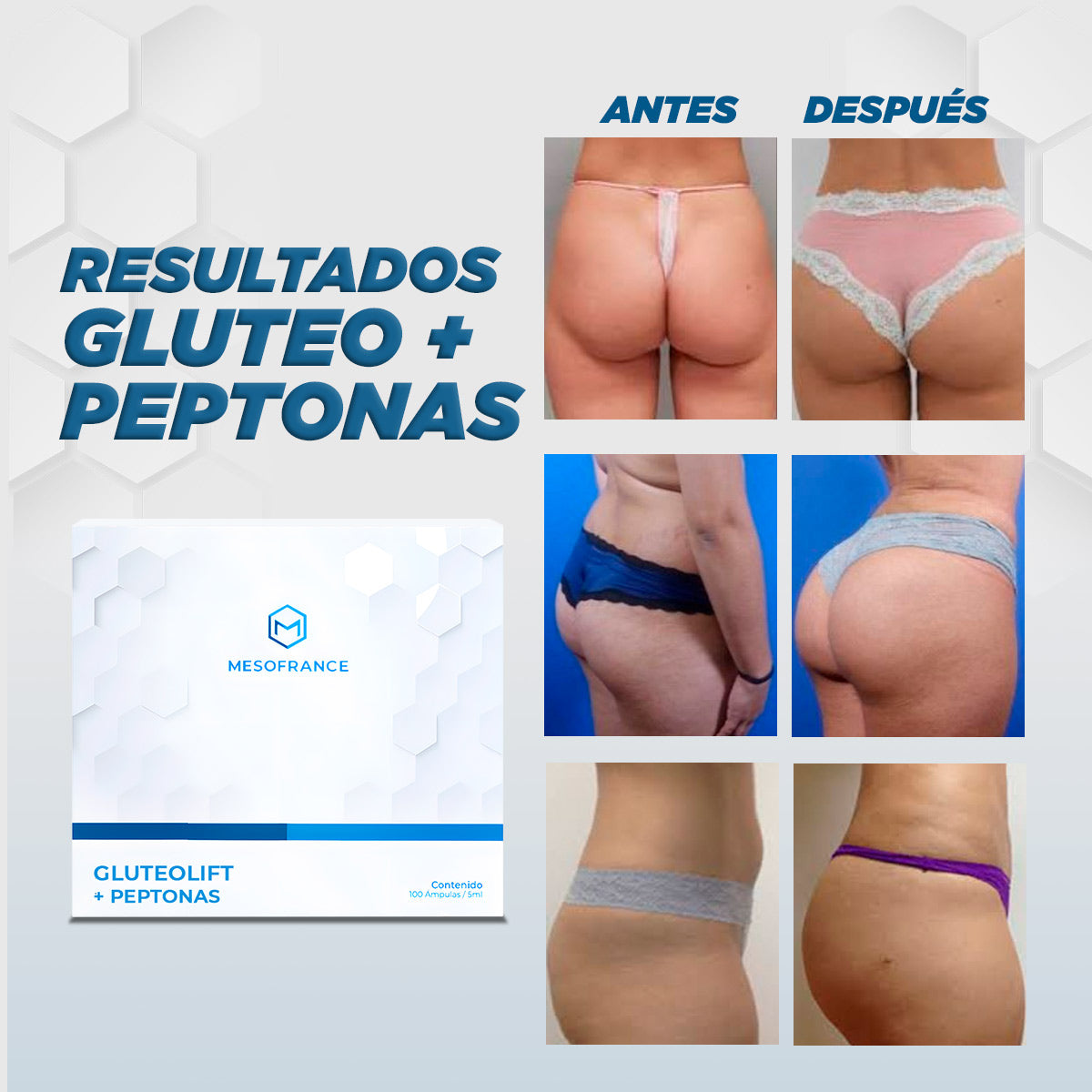 Tratamiento Glúteolift + Peptonas con Ácido Hialurónico
